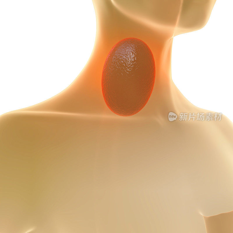 喉咙痛- 3d渲染插图